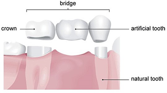 bridges